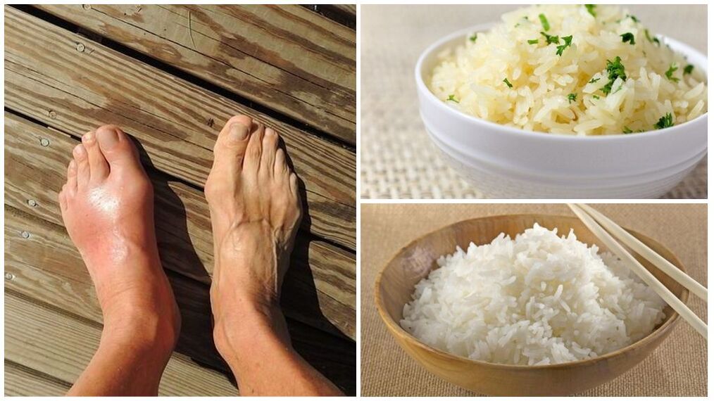 Patienten mit Gicht wird eine auf Reis basierende Diät empfohlen. 